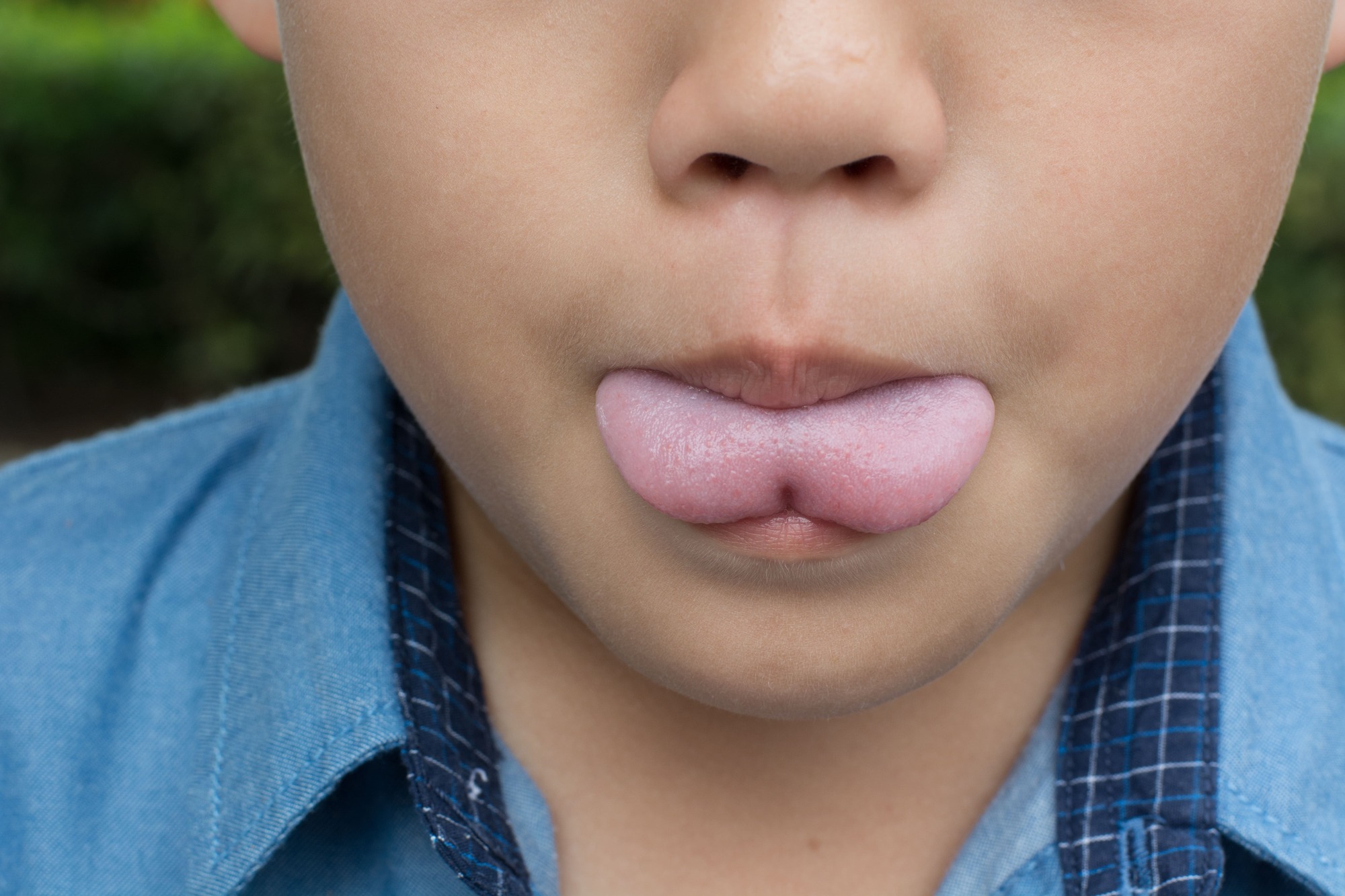 Tongue Tie Release Surgery For Ankyloglossia